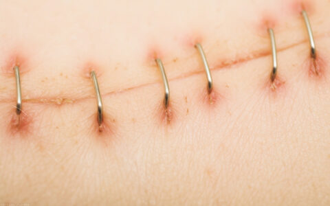 轻微伤鉴定标准及打架斗殴轻微伤处理方法